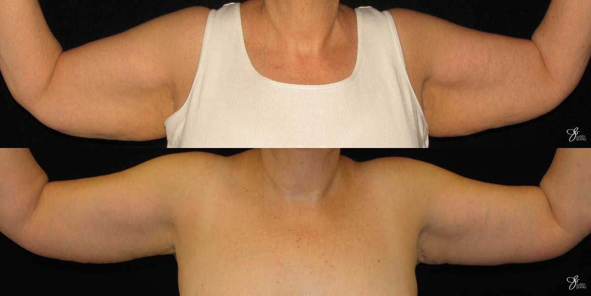 Arm Lift Before & After
