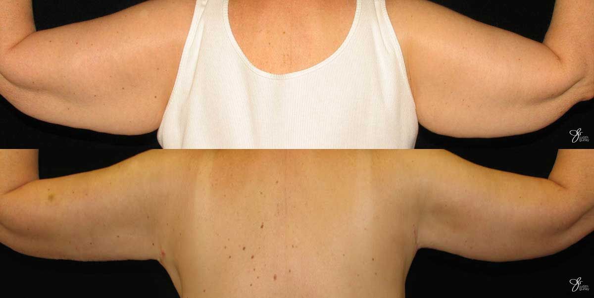 Arm Lift Before & After