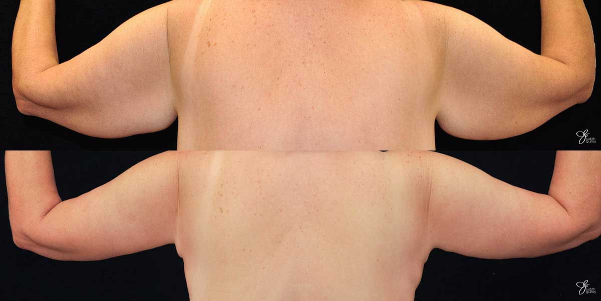 Arm Lift Before & After