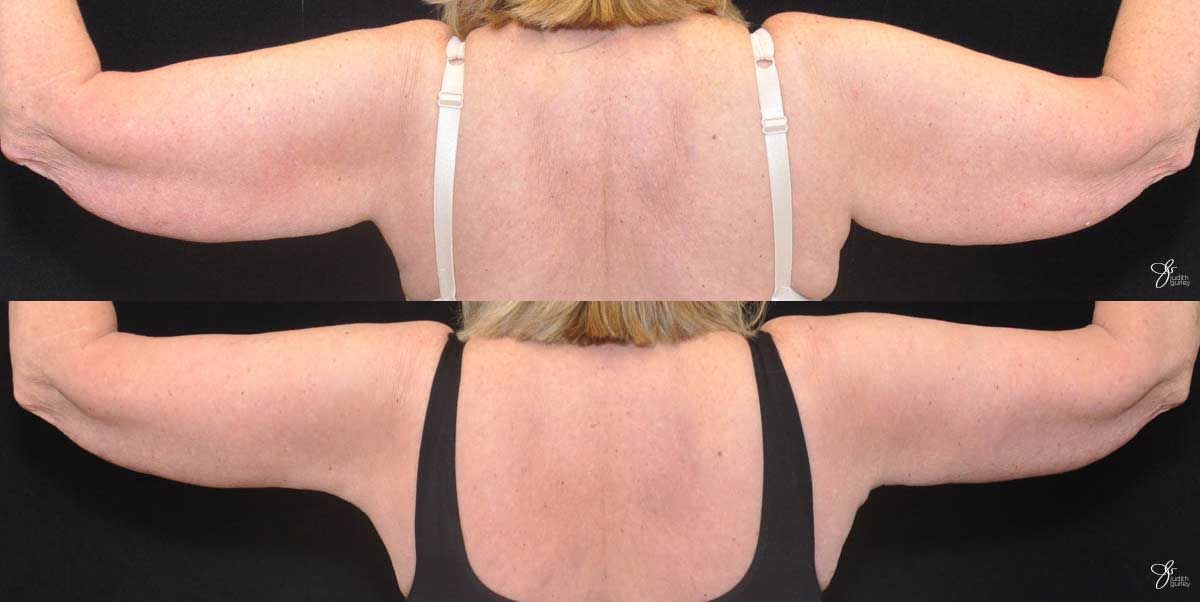 Arm Lift Before & After