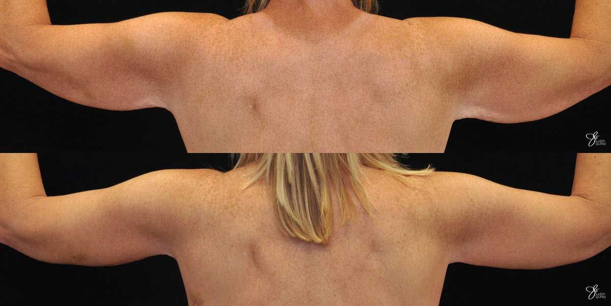 Arm Lift Before & After