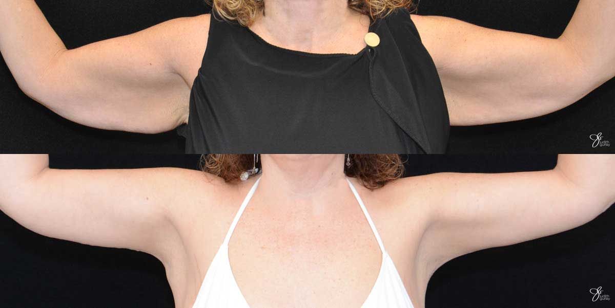 Arm Lift Before & After