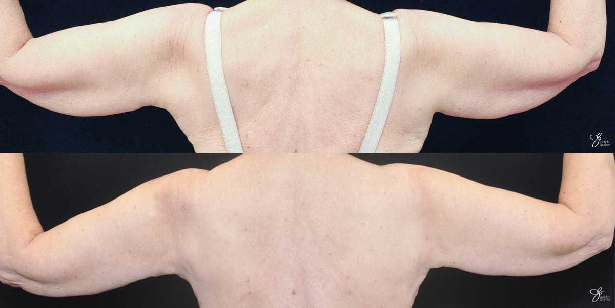 Arm Lift Before & After