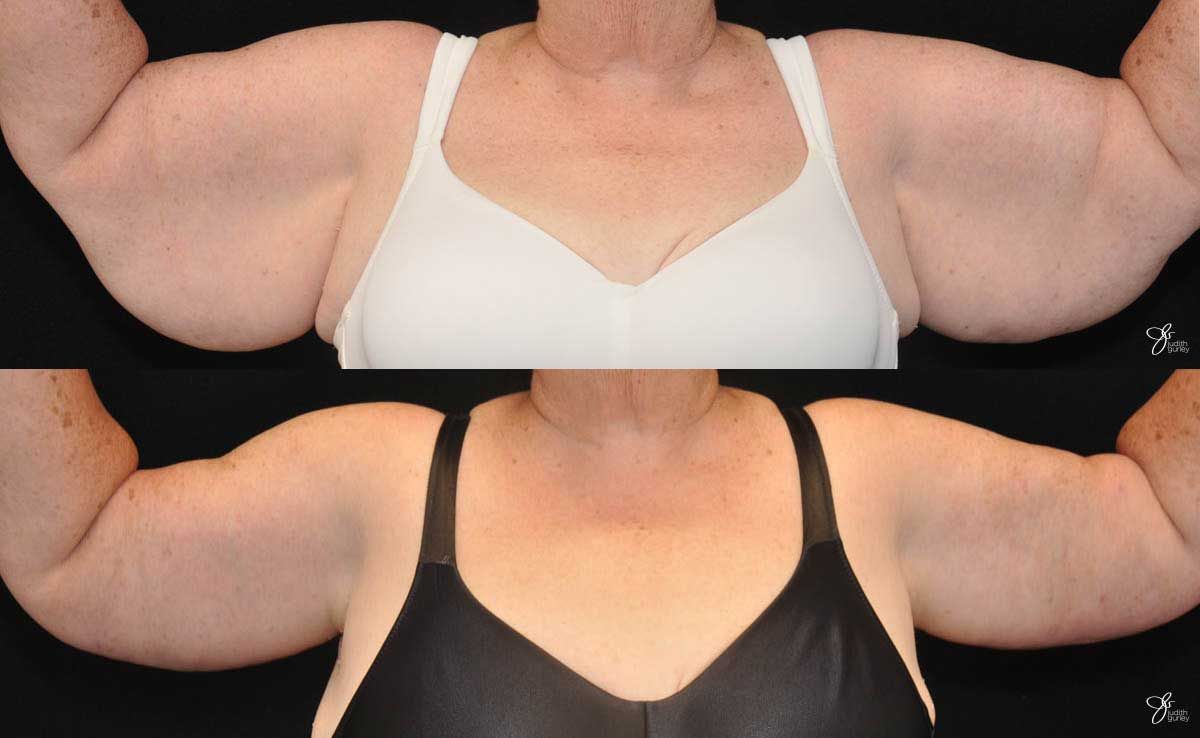 Arm Lift Before & After