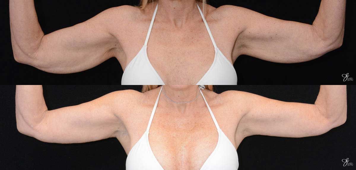 Arm Lift Before & After