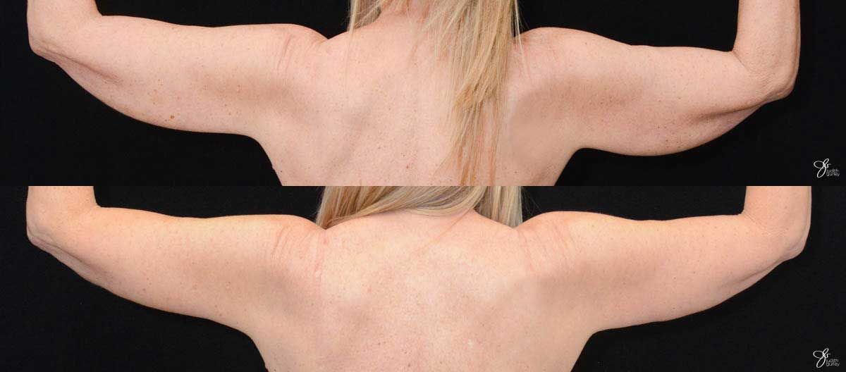 Arm Lift Before & After