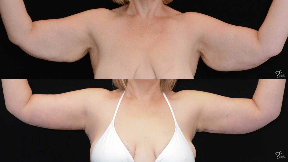 Arm Lift Before & After