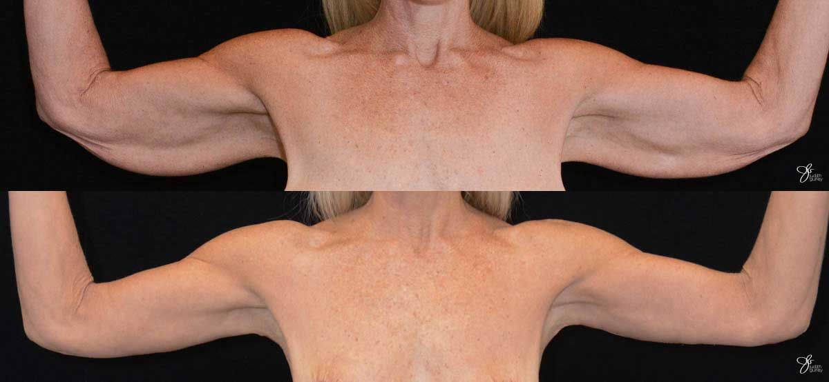 Arm Lift Before & After