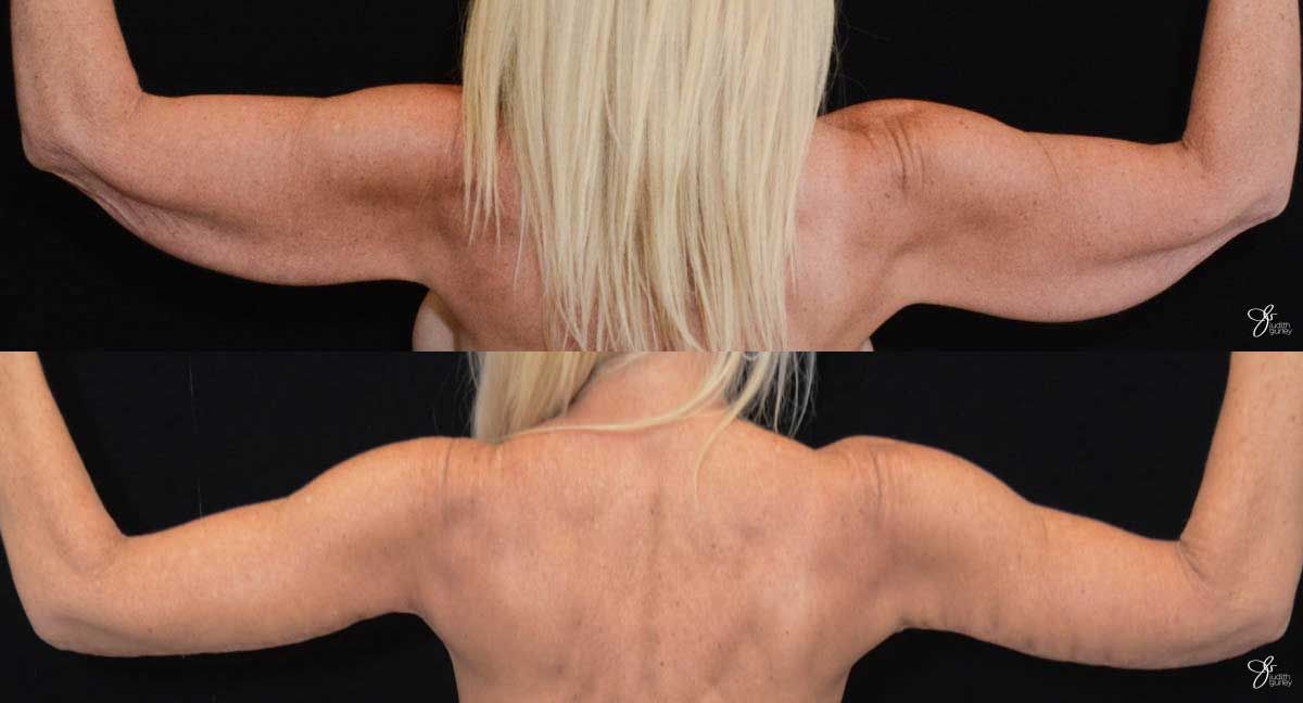 Arm Lift Before & After