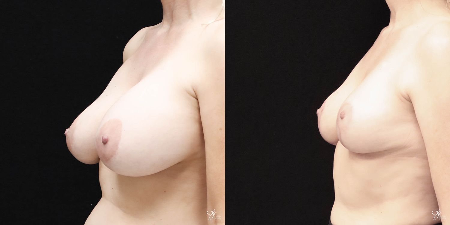 Breast Implant Removal With Lift Before & After
