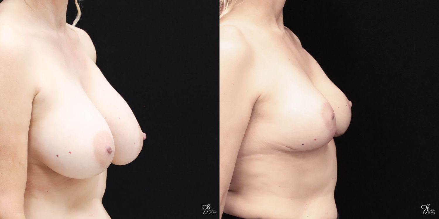 Breast Implant Removal With Lift Before & After