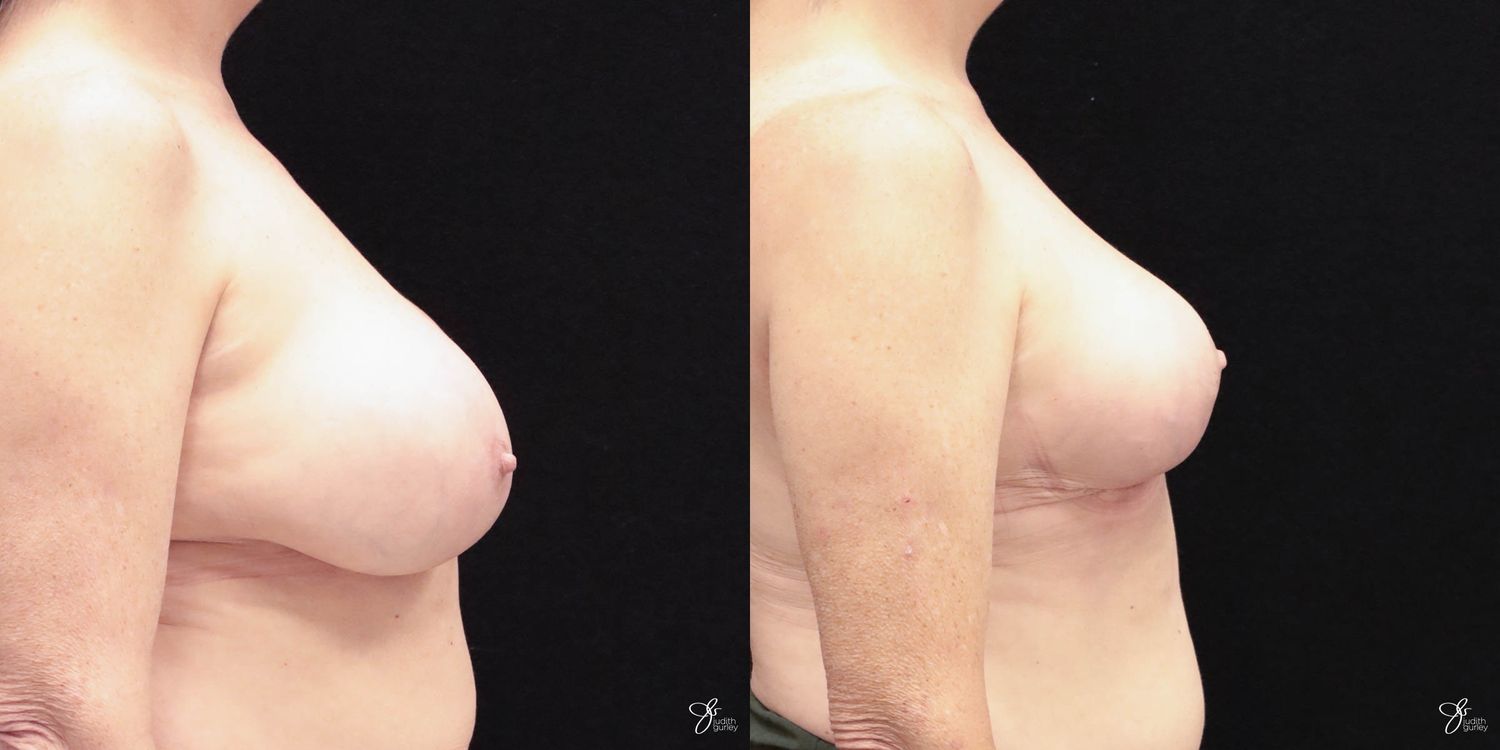 Breast Implant Removal With Lift Before & After