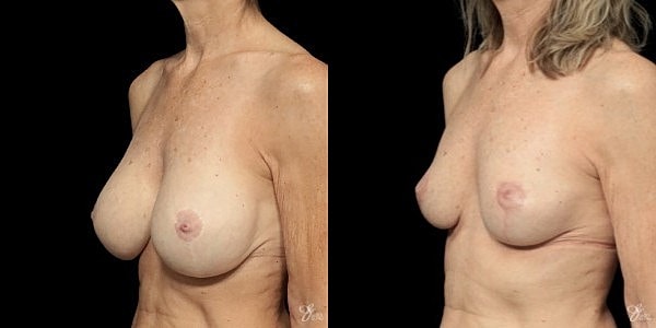 Breast Implant Removal With Lift Before & After