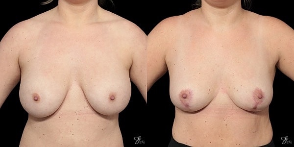 Breast Implant Removal With Lift Before & After