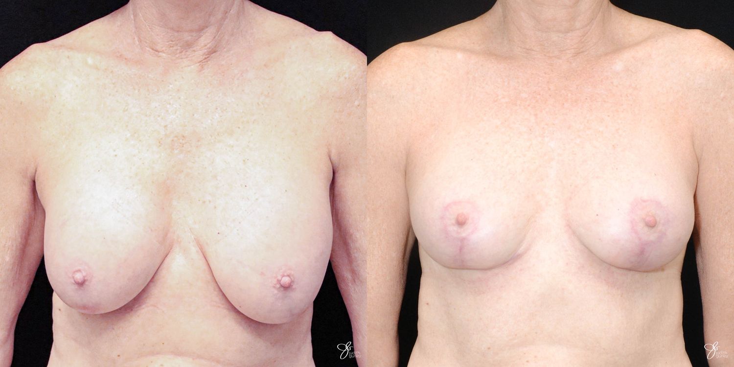Breast Implant Removal With Lift Before & After