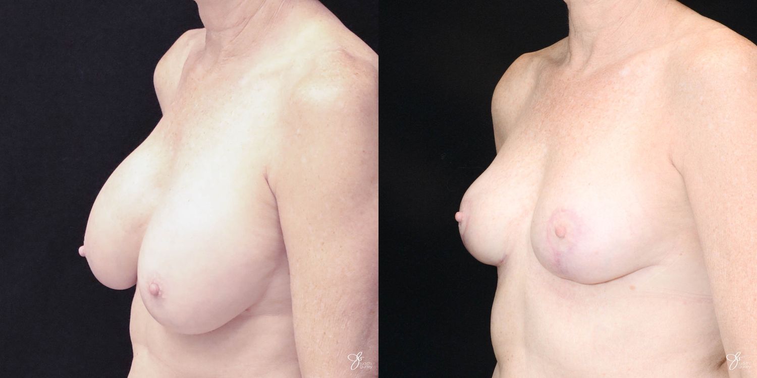 Breast Implant Removal With Lift Before & After