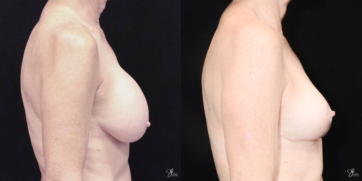 Breast Implant Removal With Lift Before & After