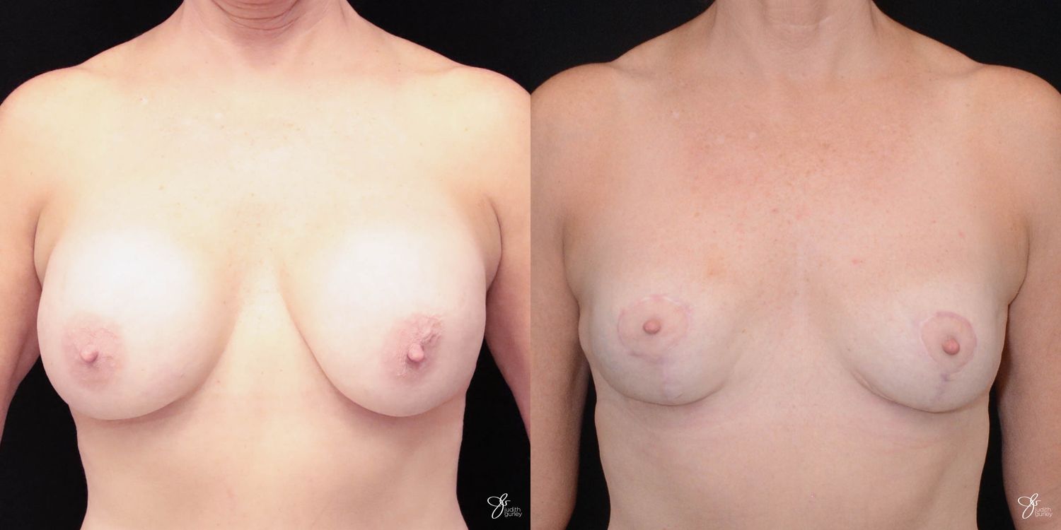 Breast Implant Removal With Lift Before & After