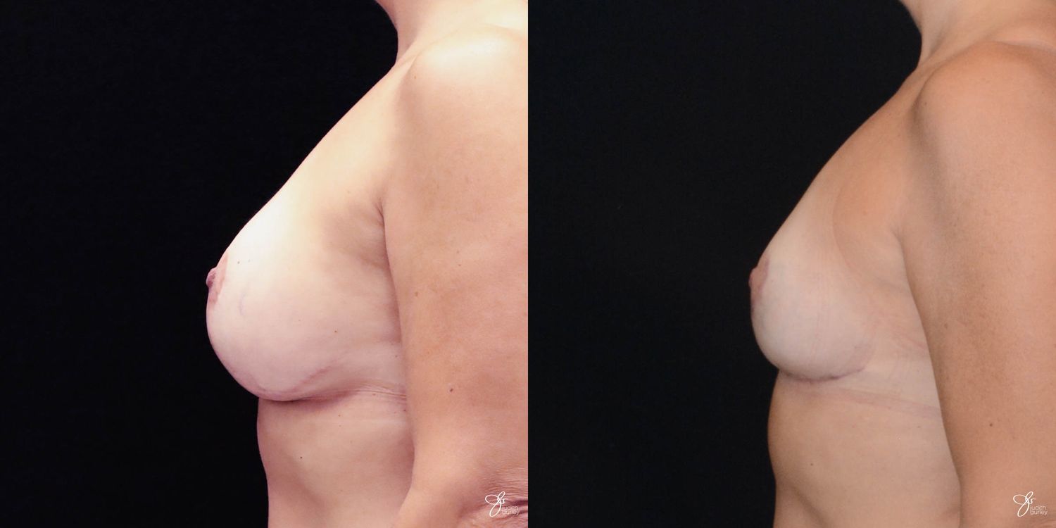 Breast Implant Removal With Lift Before & After