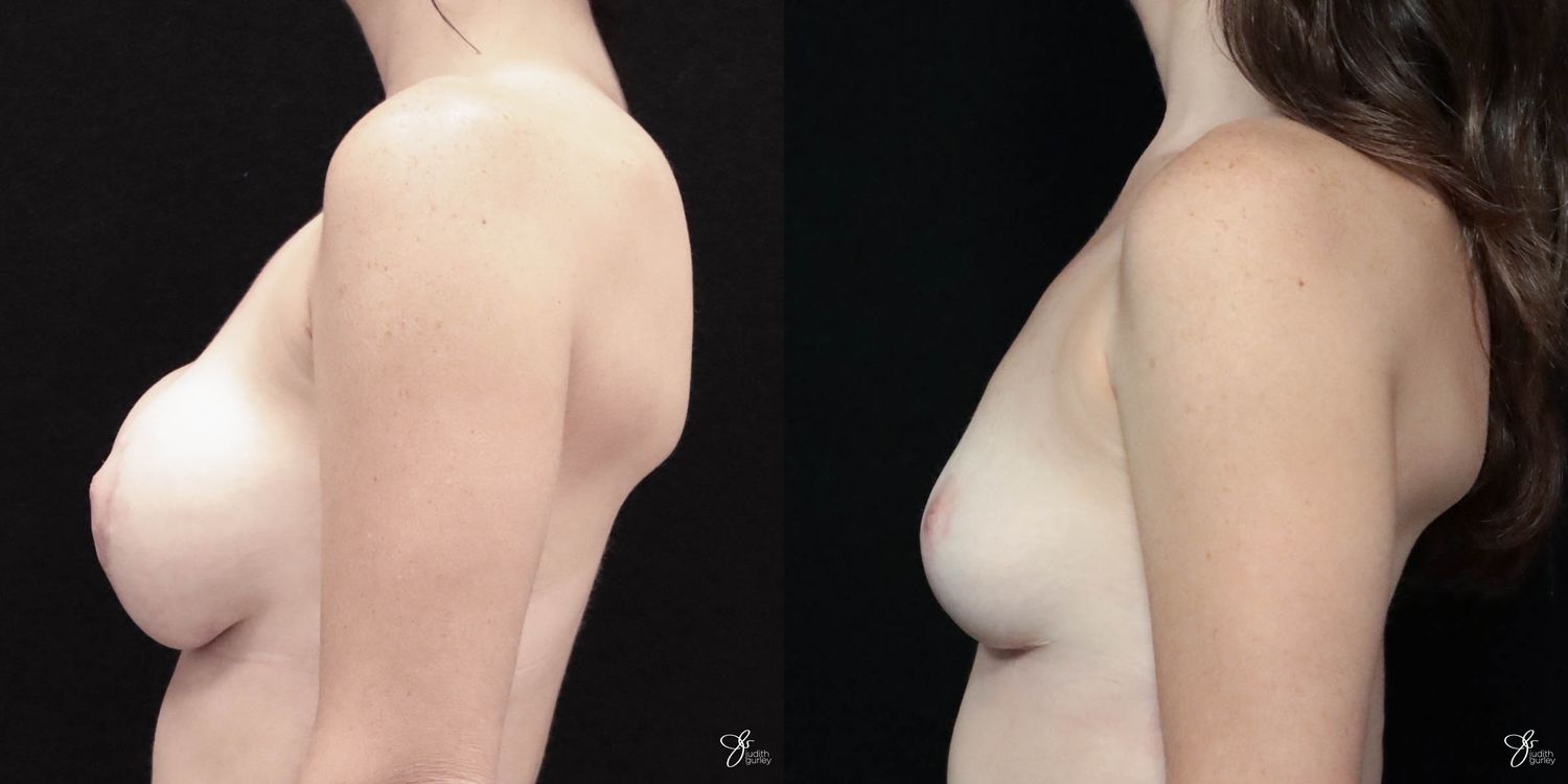 Breast Implant Removal With Lift Before & After