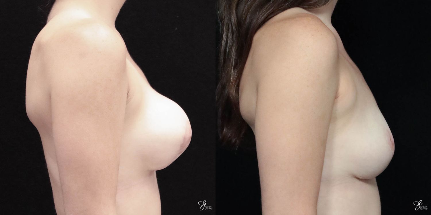 Breast Implant Removal With Lift Before & After