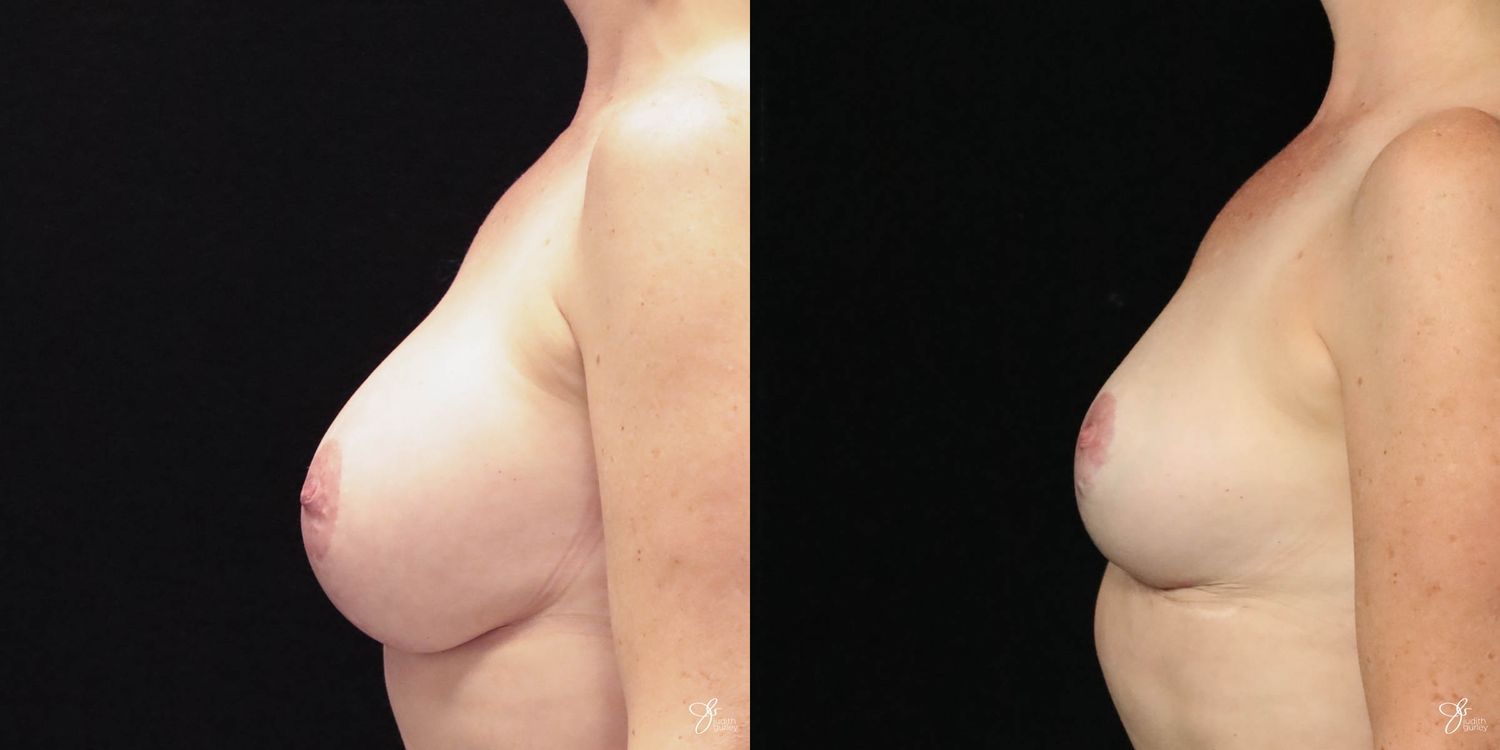 Breast Implant Removal With Lift Before & After