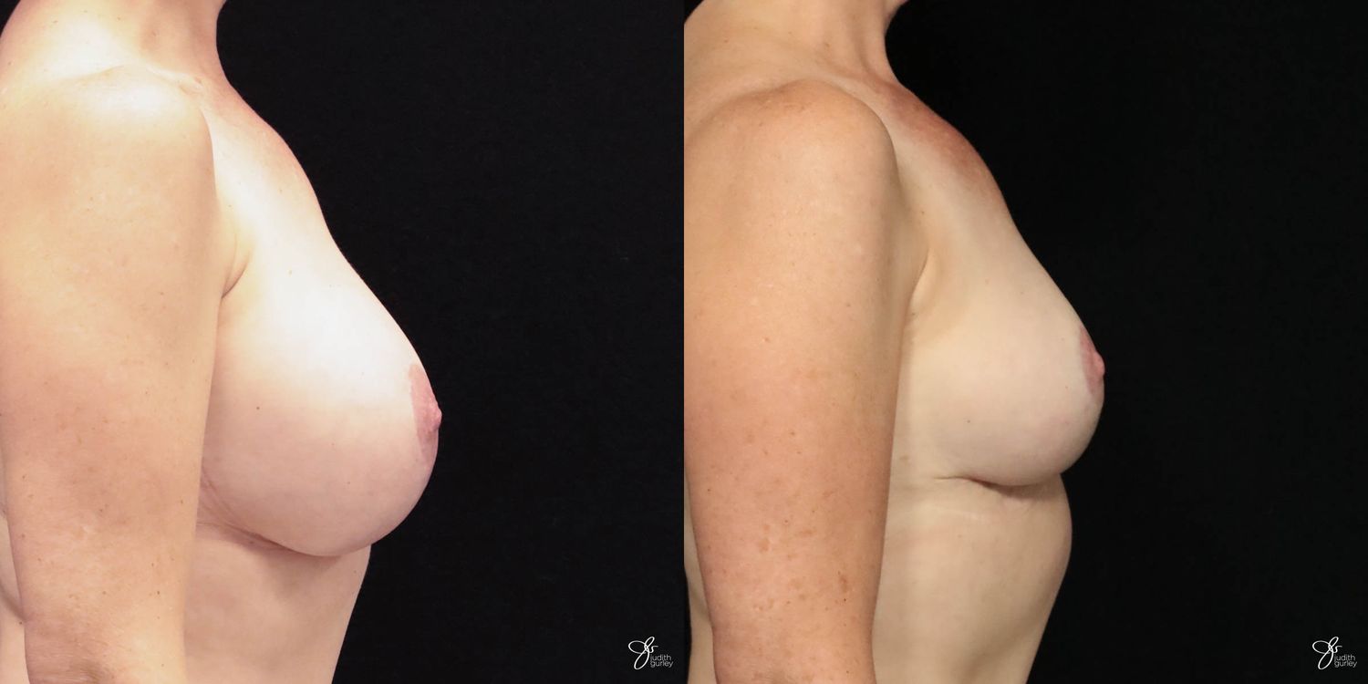 Breast Implant Removal With Lift Before & After