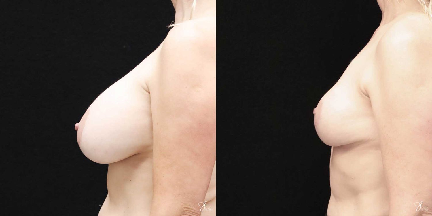 Breast Implant Removal With Lift Before & After