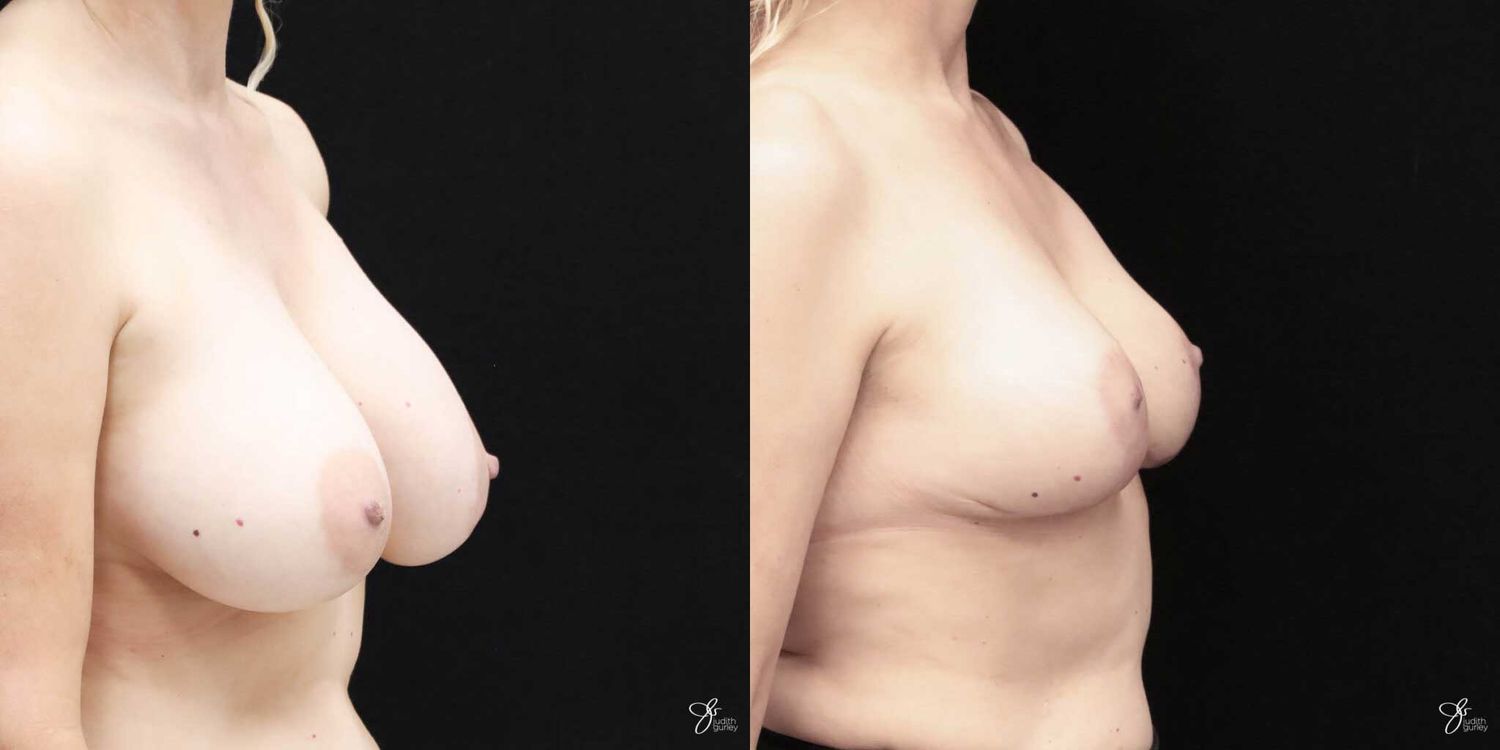 Breast Implant Removal With Lift Before & After