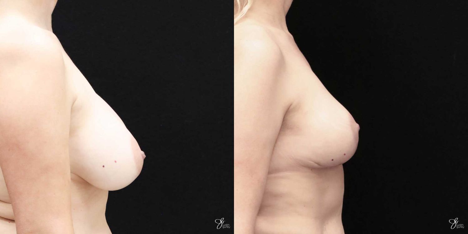 Breast Implant Removal With Lift Before & After