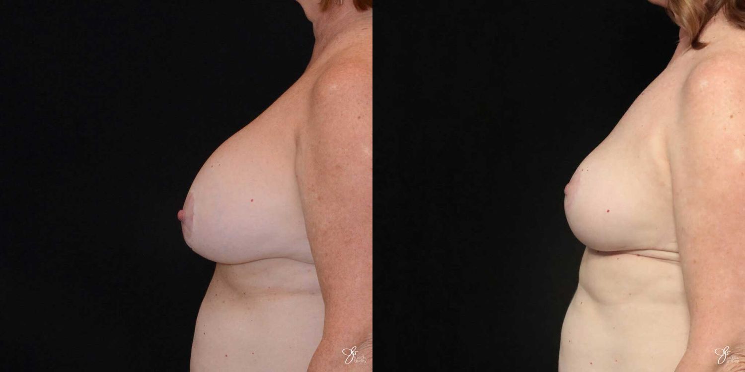 Breast Implant Removal With Lift Before & After