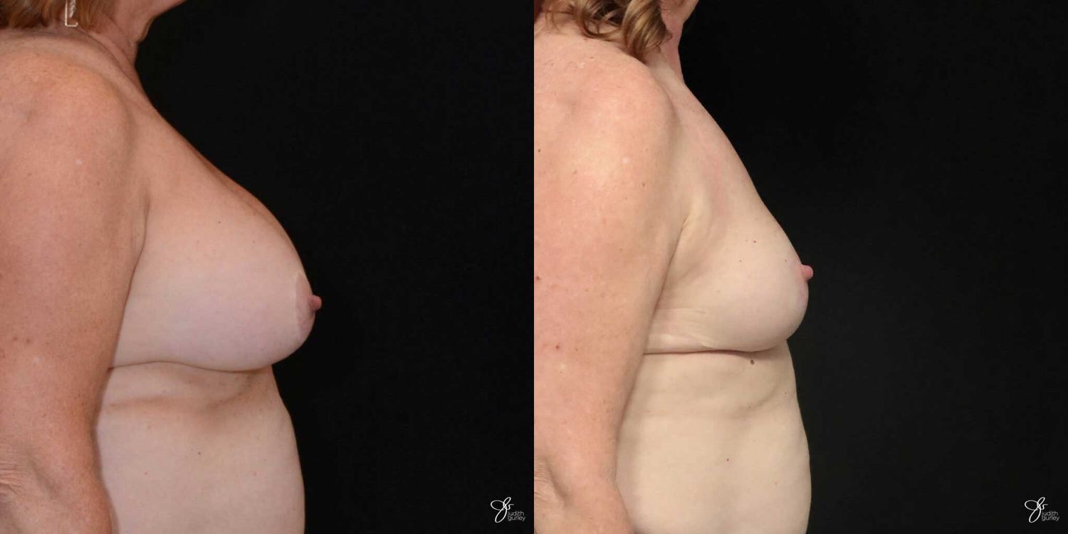 Breast Implant Removal With Lift Before & After