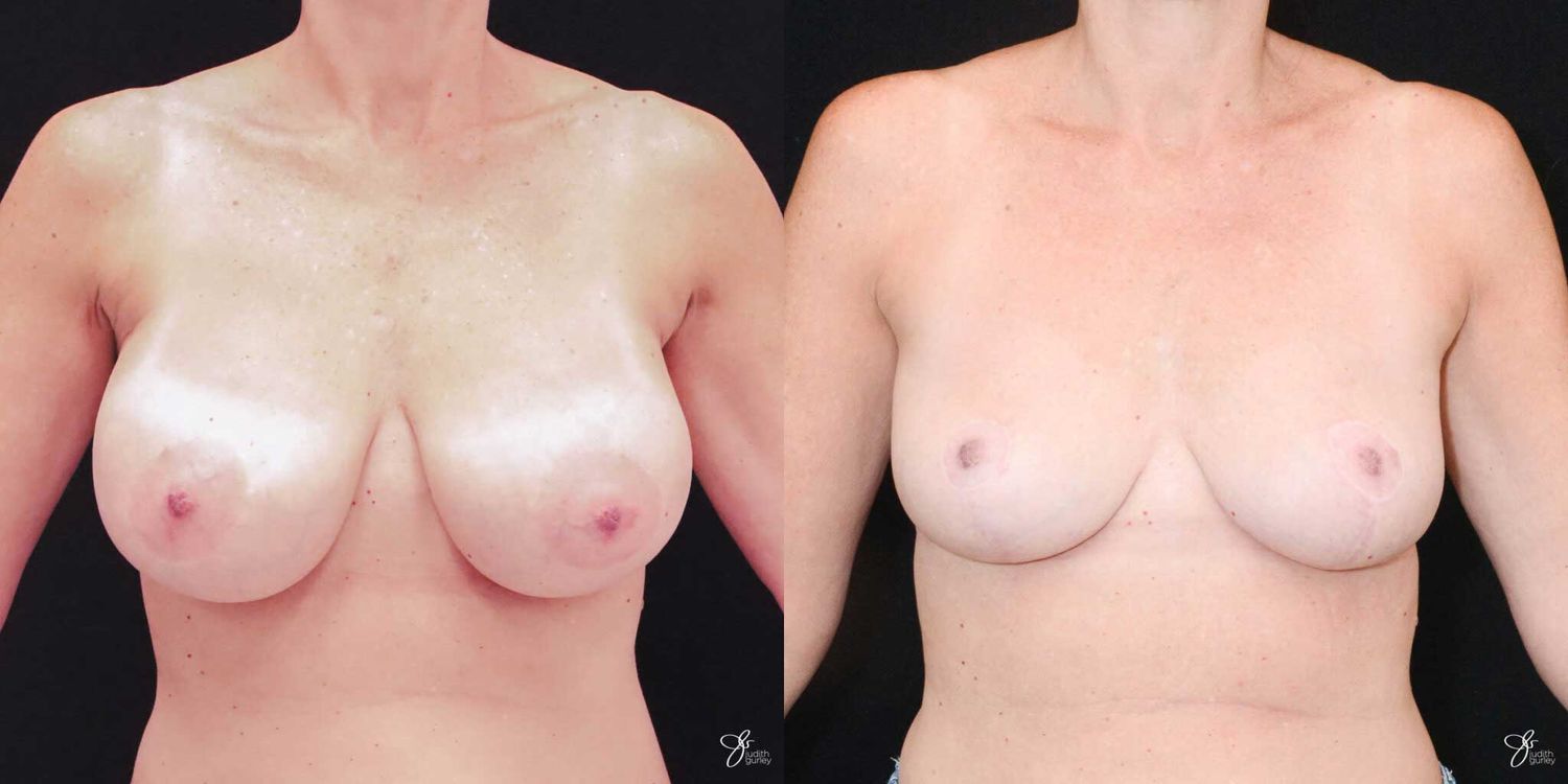 Breast Implant Removal With Lift Before & After