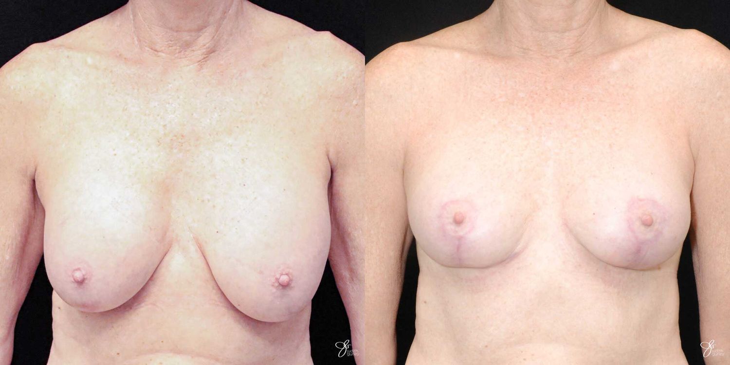 Breast Implant Removal With Lift Before & After
