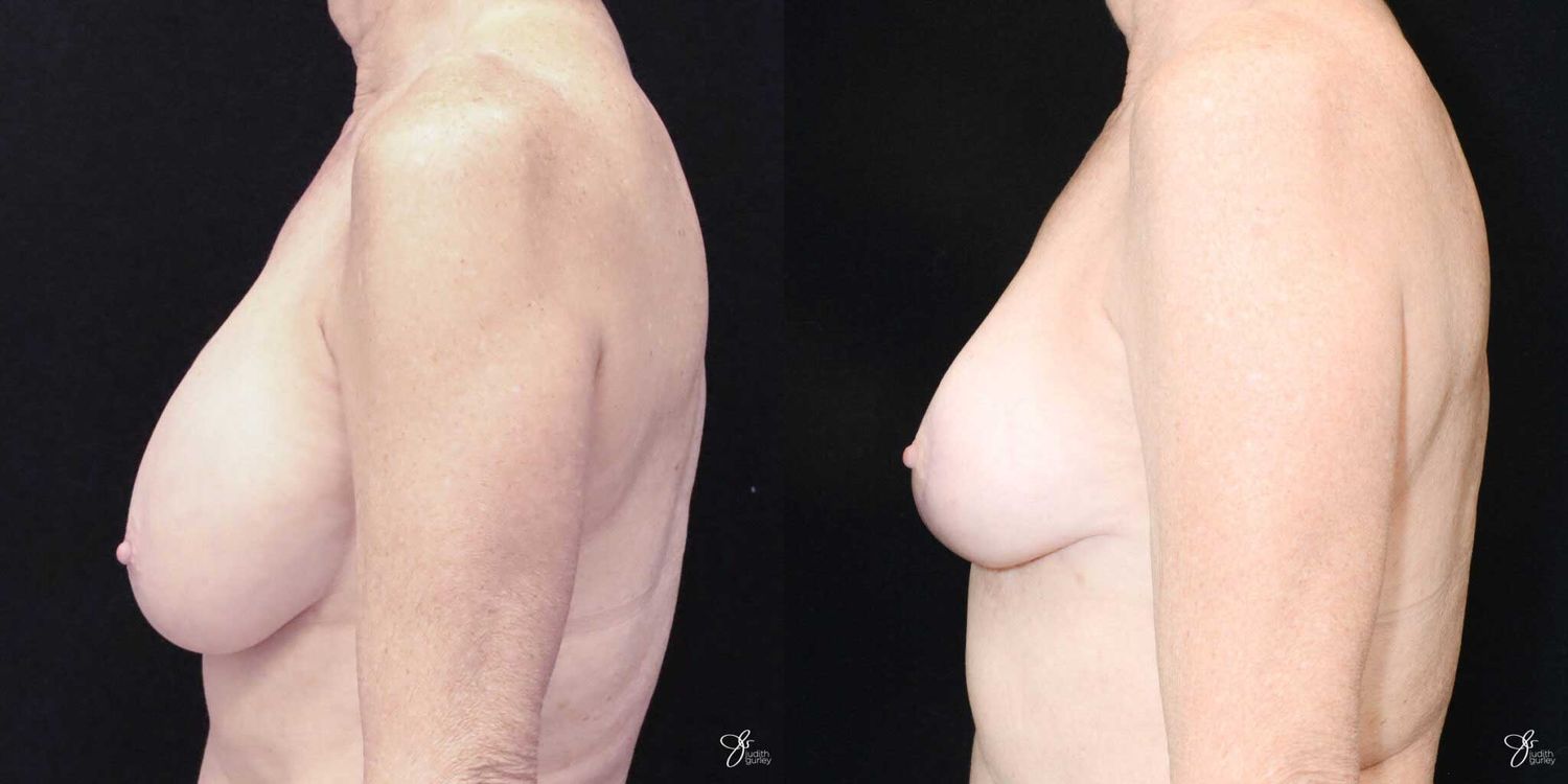 Breast Implant Removal With Lift Before & After