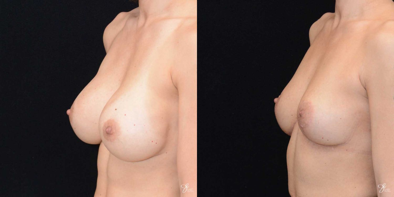 Breast Implant Removal With Lift Before & After