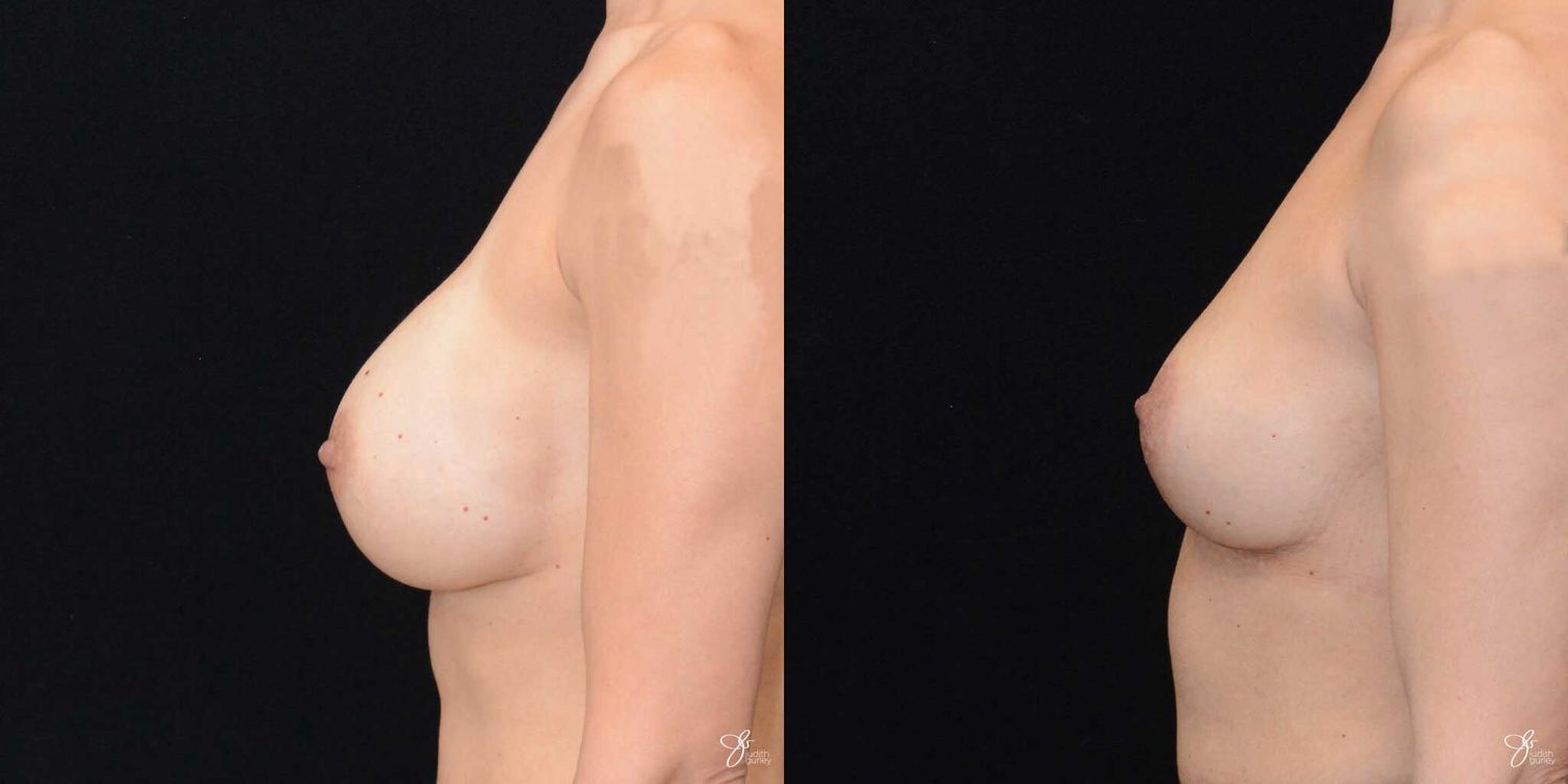 Breast Implant Removal With Lift Before & After