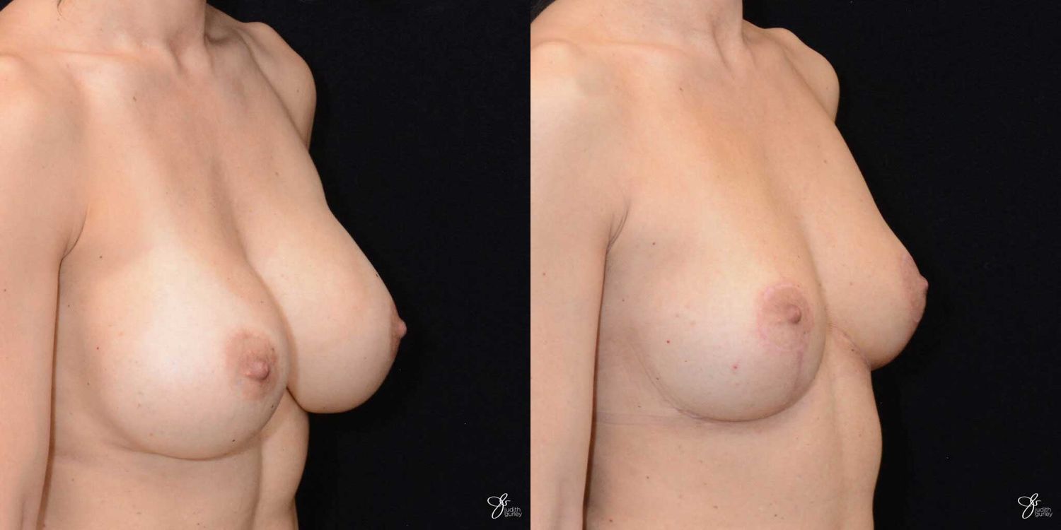 Breast Implant Removal With Lift Before & After