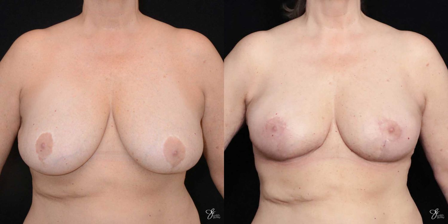 Breast Implant Removal With Lift Before & After