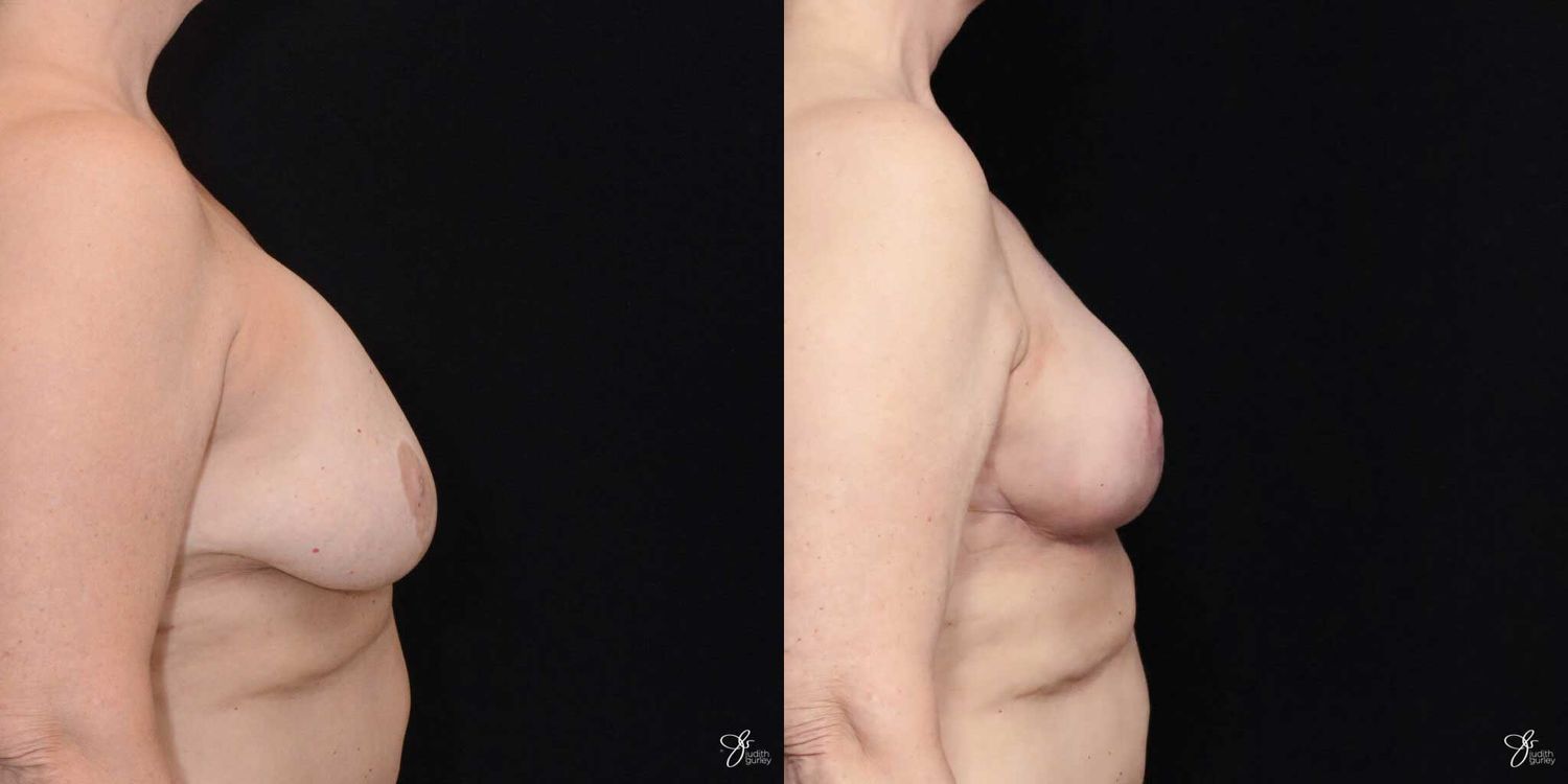 Breast Implant Removal With Lift Before & After