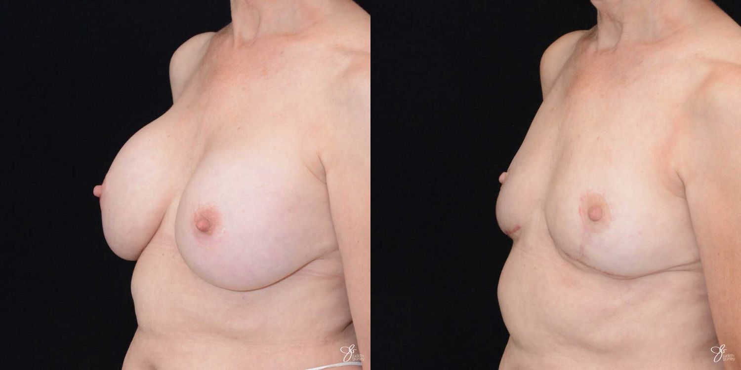 Breast Implant Removal With Lift Before & After