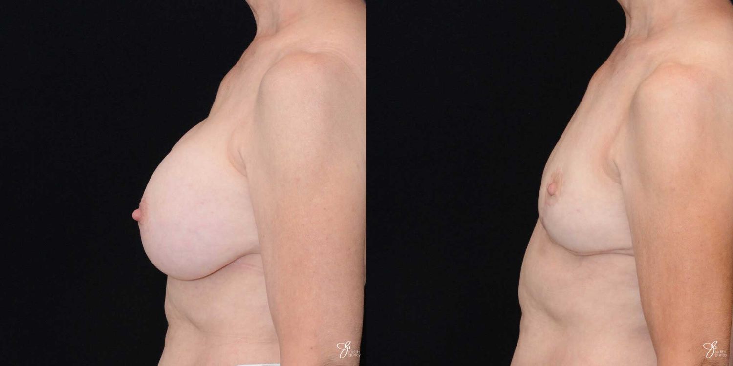 Breast Implant Removal With Lift Before & After