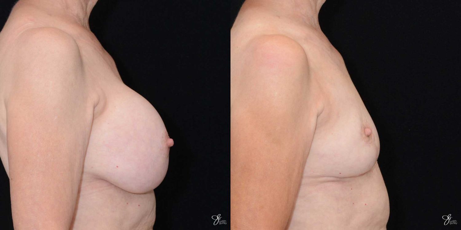 Breast Implant Removal With Lift Before & After