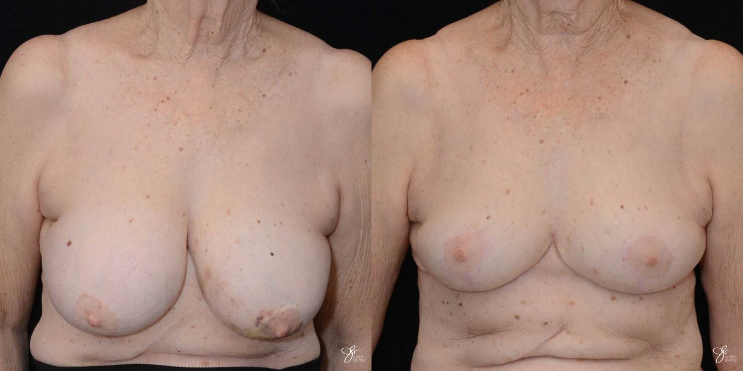 Breast Implant Removal With Lift Before & After