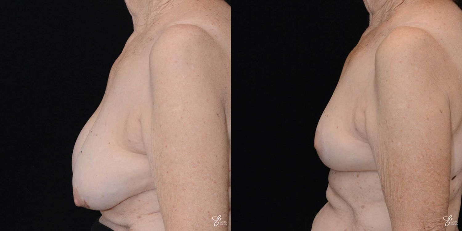 Breast Implant Removal With Lift Before & After