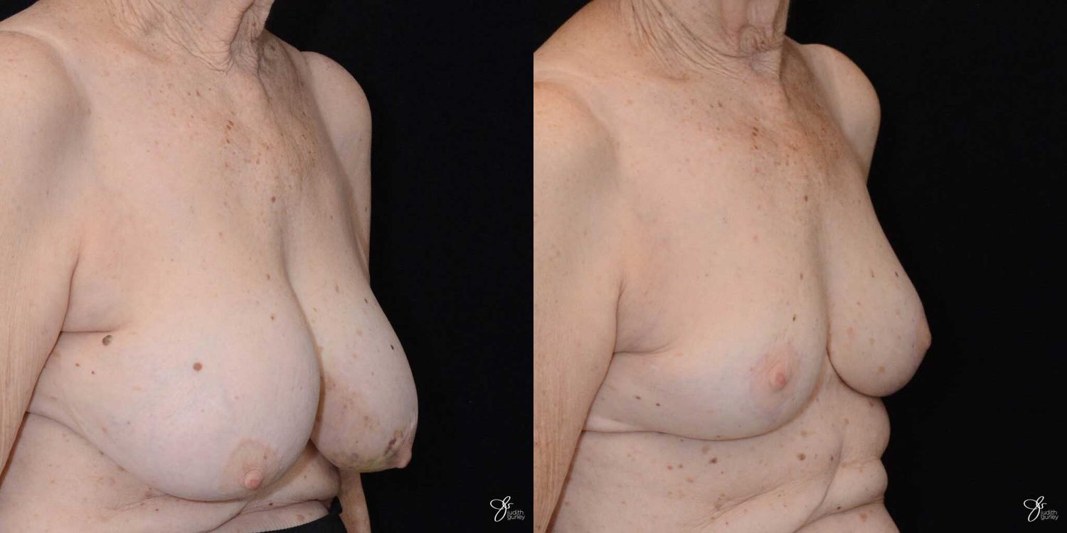 Breast Implant Removal With Lift Before & After