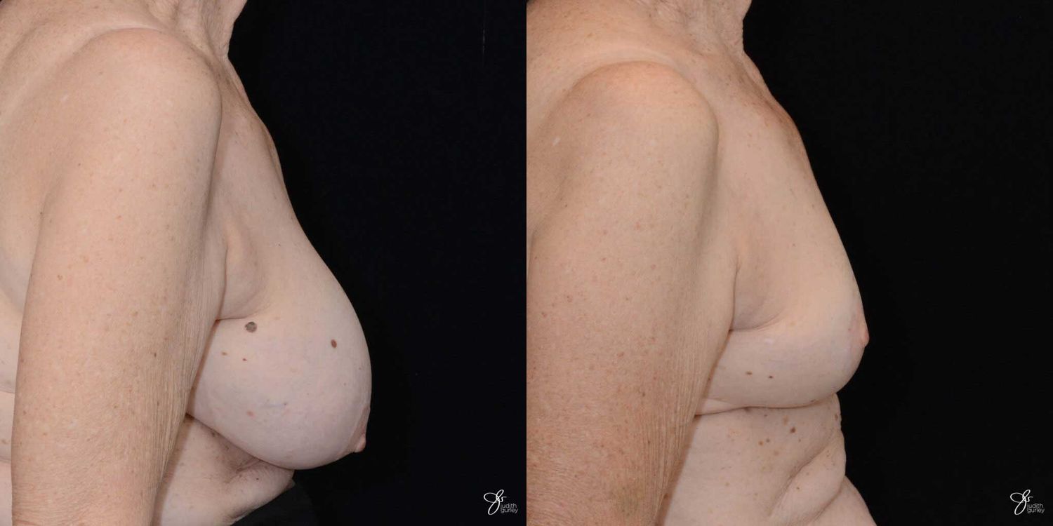 Breast Implant Removal With Lift Before & After