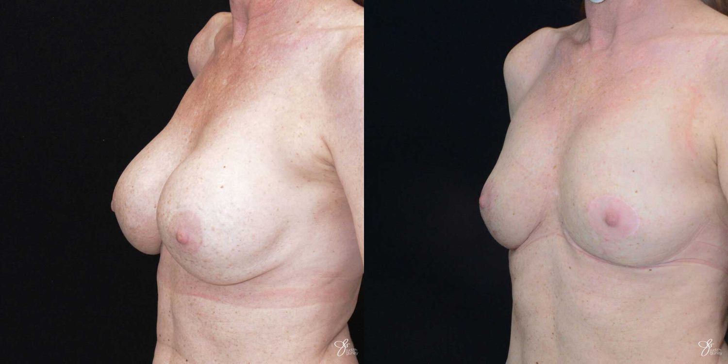 Breast Implant Removal With Lift Before & After