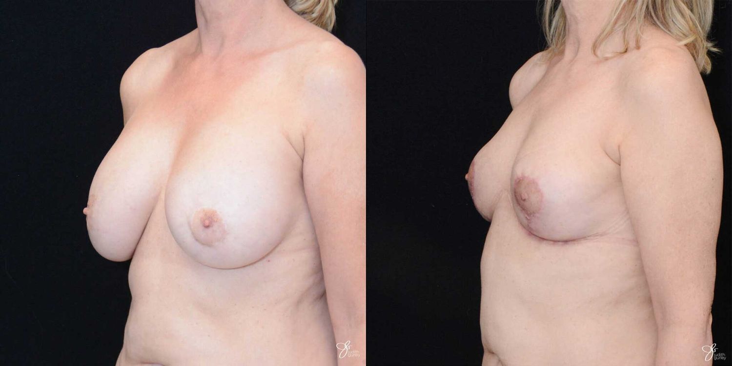 Breast Implant Removal With Lift Before & After