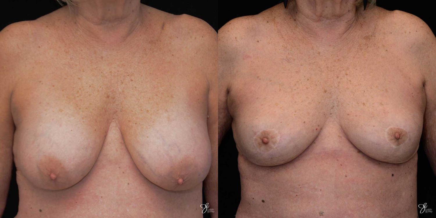 Breast Implant Removal With Lift Before & After